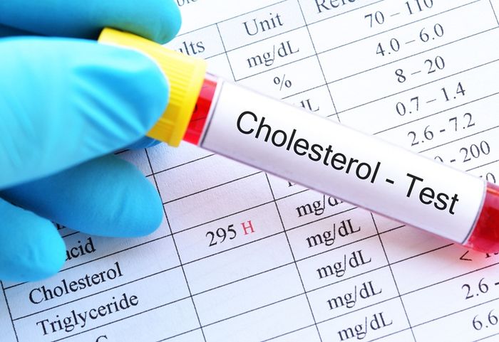 Kiểm tra máu để biết chính xác hàm lượng cholesterol trong cơ thể