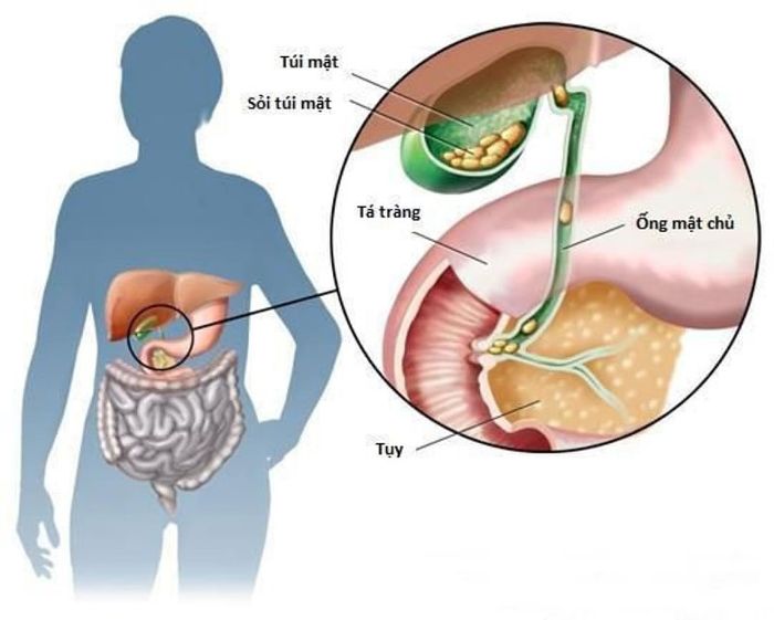 Phân tích về quá trình hình thành sỏi túi mật