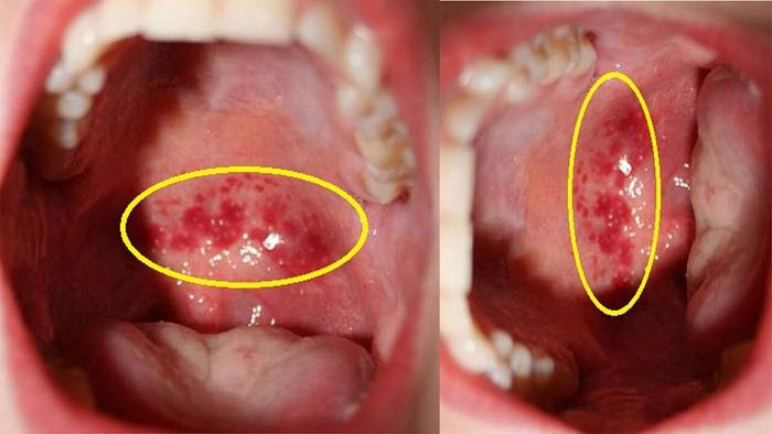 Viêm họng hạt tạo ra những hạt nhỏ như hạt đậu ở cổ họng