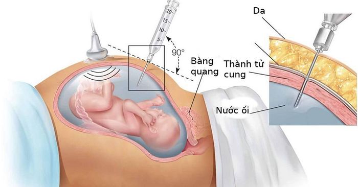 Sàng lọc trước sinh hỗ trợ phát hiện dị tật bẩm sinh từ sớm trong thai kỳ