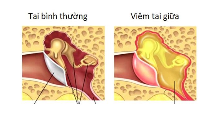 Viêm tai giữa là một trong những nguyên nhân gây ra chảy mủ từ tai