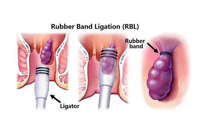 Rụng trĩ bằng cách thắt vòng cao su xung quanh