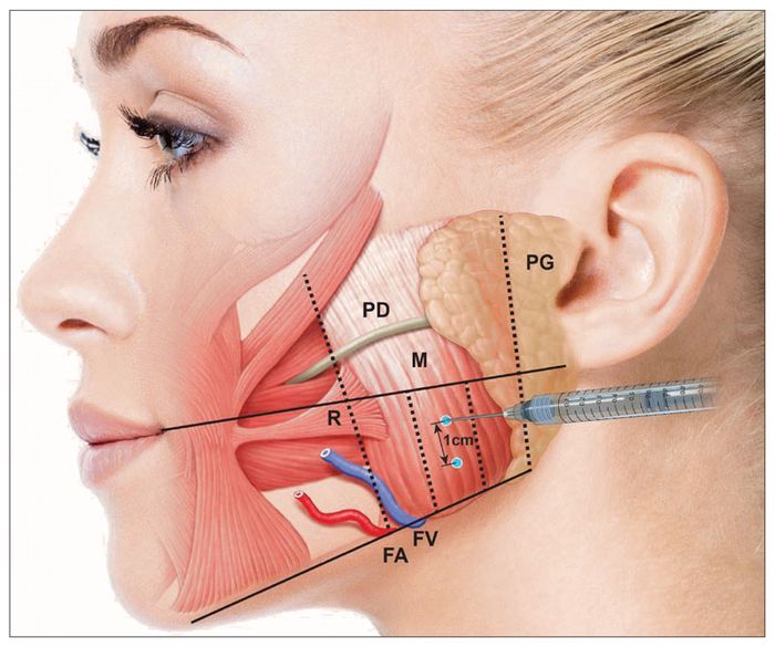 Tiêm Botox giúp cải thiện tình trạng nghiến răng và giảm căng thẳng cho cơ hàm