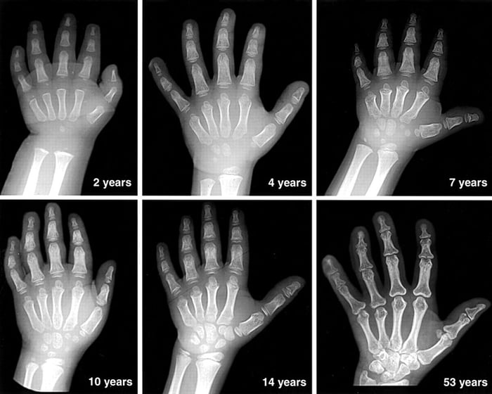 Để xác định tuổi xương, bác sĩ sẽ sử dụng kỹ thuật chẩn đoán hình ảnh X-quang.
