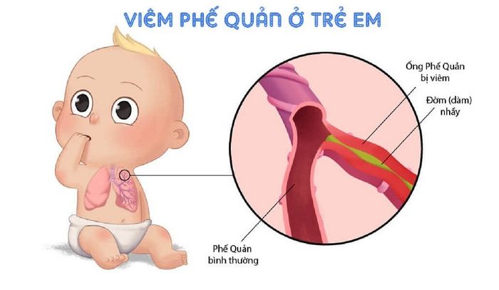 Viêm phế quản có thể là nguyên nhân khiến trẻ bị ho, sổ mũi, thở khò khè.