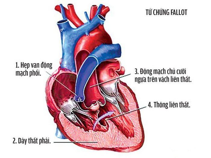 Bất thường về tim là một trong những loại dị tật thường gặp ở trẻ sơ sinh