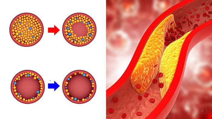 Tình trạng cholesterol máu cao