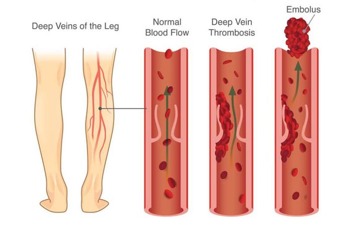 Hệ thống tuần hoàn kém hiệu quả gây ra huyết khối