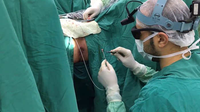 Phẫu thuật rò hậu môn sớm sẽ không phức tạp
