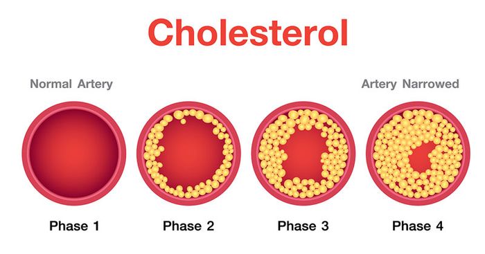 Bệnh nhân mắc đái tháo đường thường gặp vấn đề về Cholesterol