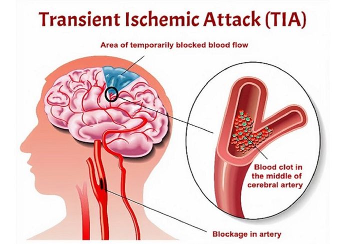 Đột quỵ do thiếu máu cục bộ là phổ biến nhất