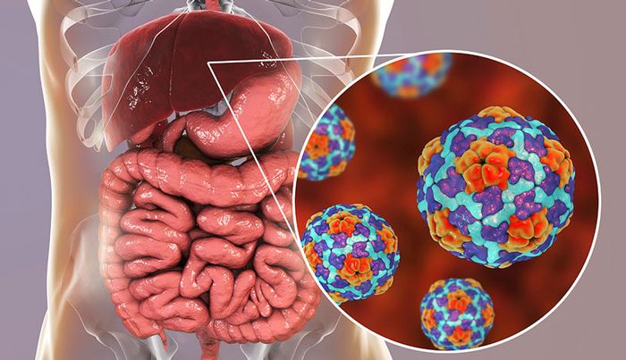 Virus Hepatitis A gây ra bệnh viêm gan A