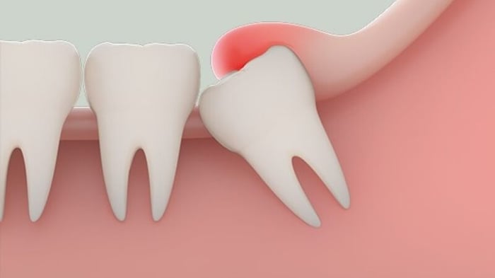 Răng khôn mọc chen lấn vào các răng lân cận có thể gây ra đau đớn nghiêm trọng.