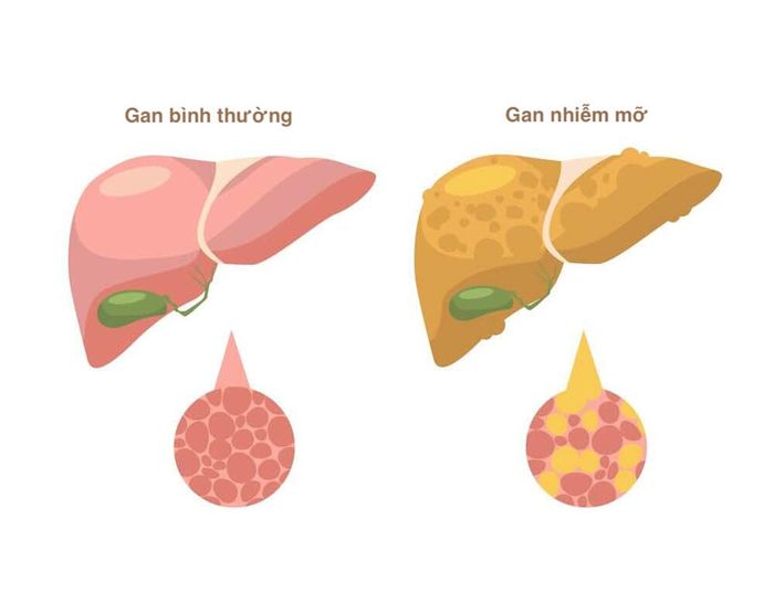 Bệnh gan nhiễm mỡ thường được phát hiện thông qua siêu âm hoặc xét nghiệm máu trong các cuộc kiểm tra sức khỏe định kỳ