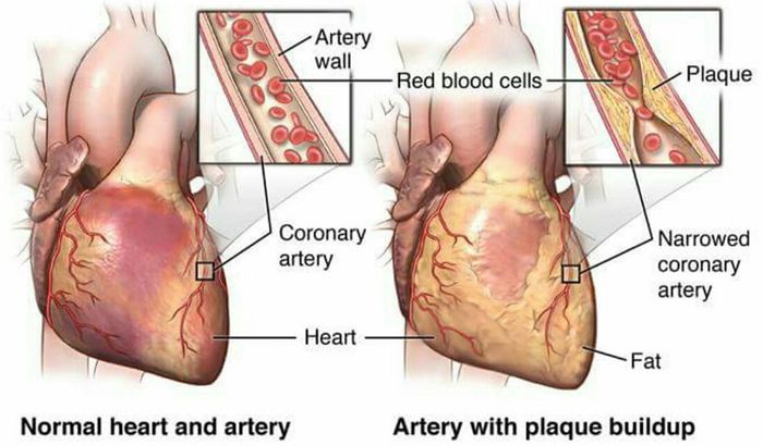 Bệnh thiếu máu cục bộ có thể gây ra vấn đề cho hệ tim mạch