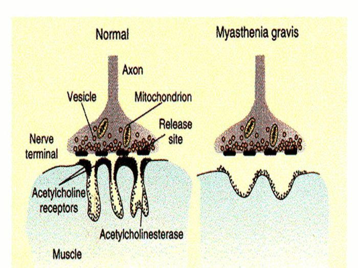 Kháng thể tự miễn gây cản trở biệt hóa thụ thể Acetylcholin.