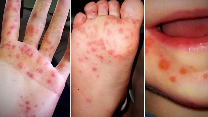 Bệnh tay chân miệng là một căn bệnh truyền nhiễm do virus trong đường ruột gây ra