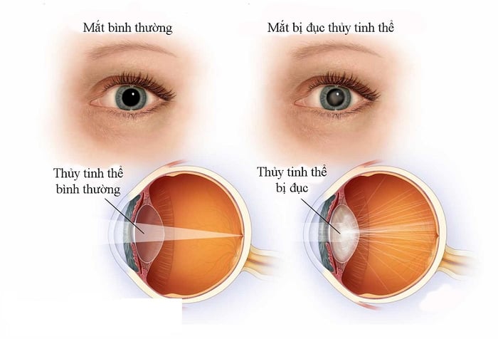 Người mắc tiểu đường thường dễ bị đục thủy tinh thể gây mờ mắt.