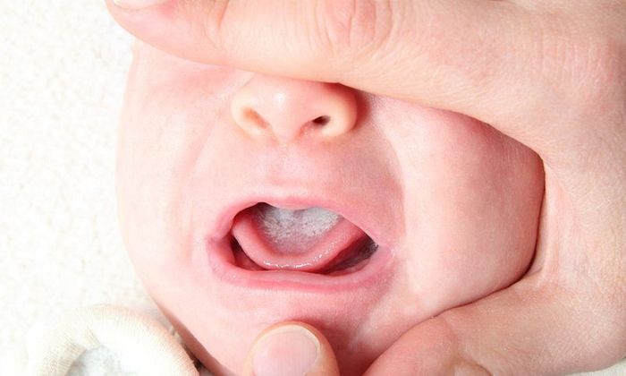 Bệnh nấm miệng gây ra triệu chứng như lưỡi trắng và mùi hôi khó chịu