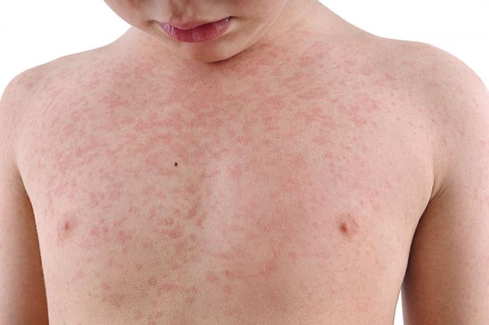 Phát ban là triệu chứng đặc trưng của bệnh rubella