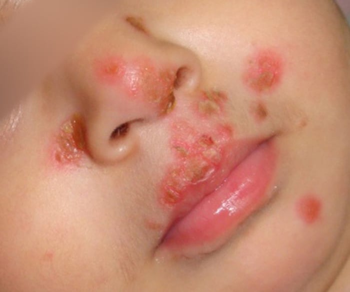 Trẻ em là nhóm nguy cơ cao mắc bệnh Herpes miệng