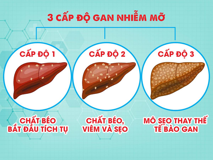 Dấu hiệu của bệnh gan nhiễm mỡ qua từng giai đoạn