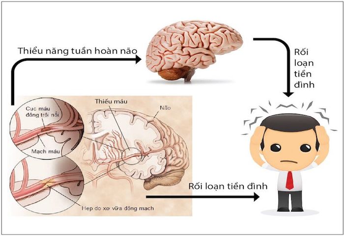 Thiếu máu não là một trong những nguyên nhân chính gây ra hội chứng tiền đình