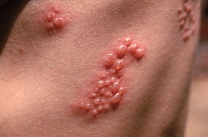 Chẩn đoán Herpes thường dựa vào các triệu chứng lâm sàng