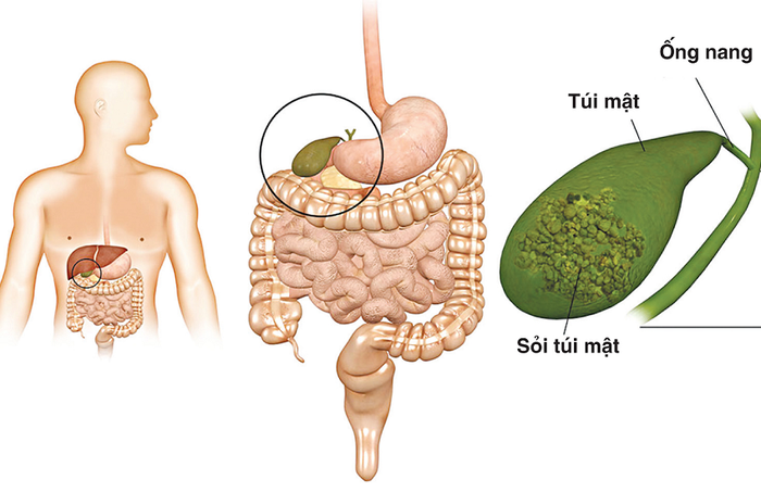 Dấu hiệu chính của sỏi mật