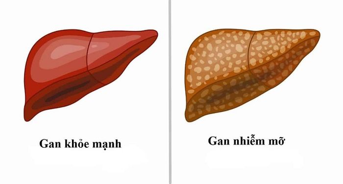 Dấu hiệu của bệnh gan nhiễm mỡ qua từng giai đoạn