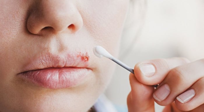 Herpes miệng thường tiến triển trong một vài ngày