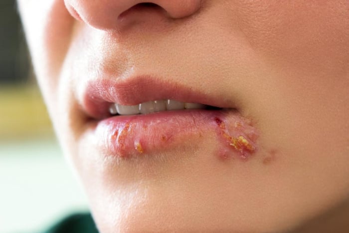 Tổn thương da ở miệng do virus Herpes gây ra