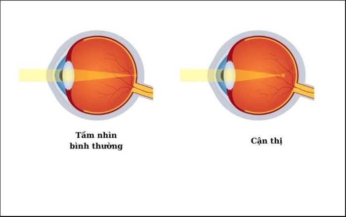 Miêu tả tình trạng mắt cận thị