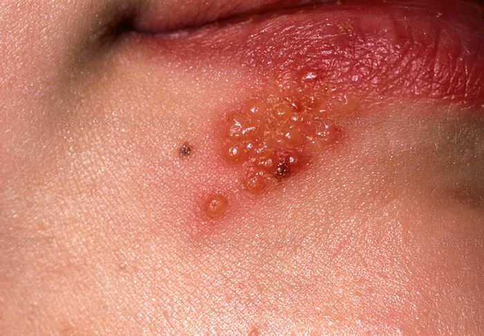 Mụn nước Herpes xuất hiện do bệnh Celiac