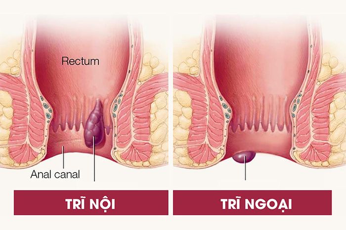 Tùy thuộc vào vị trí hình thành của búi trĩ mà bệnh được phân loại thành ba loại chính 