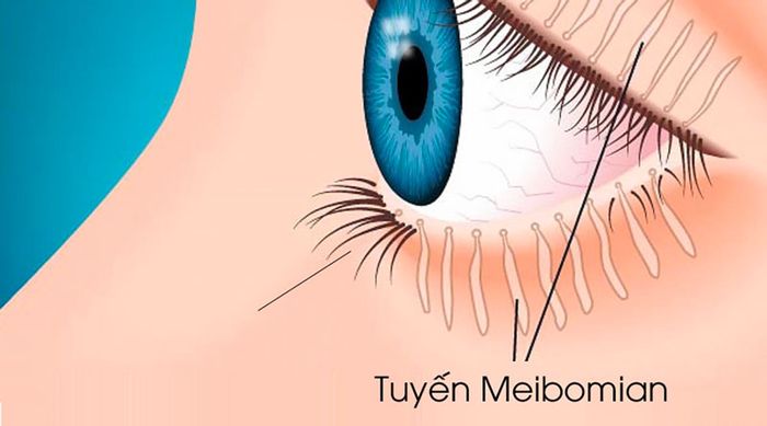 Rối loạn Tuyến Meibomian cũng là nguyên nhân được đề cập