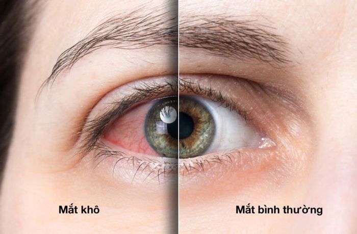 Cảm giác khó chịu do mắt khô, ngứa rát