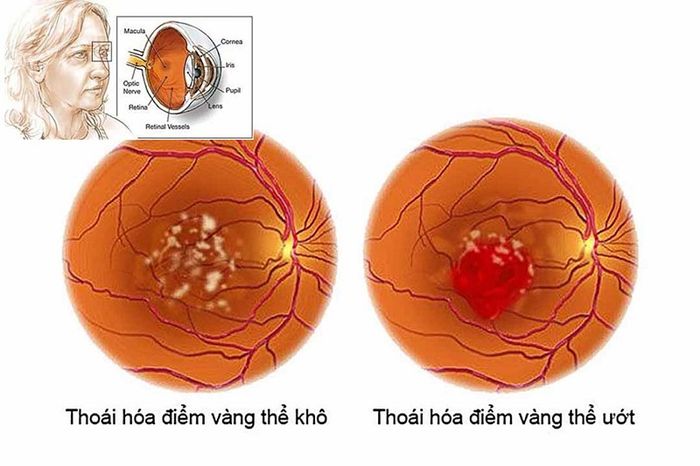 Thoái hóa điểm vàng thể ướt là một dạng của thoái hóa điểm vàng.