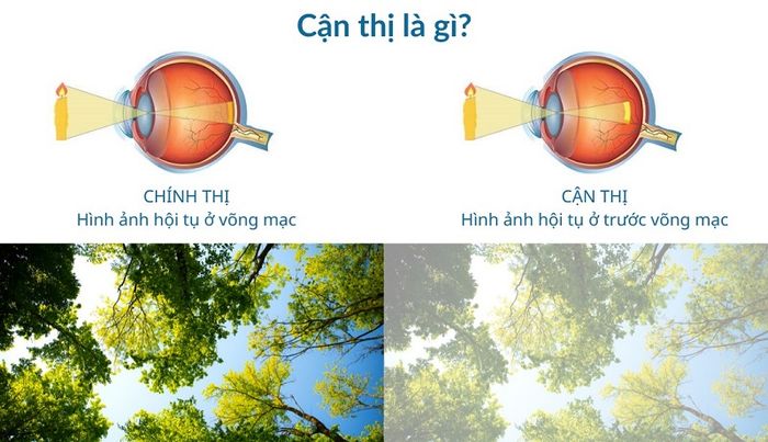 Sự mô phỏng về cận thị