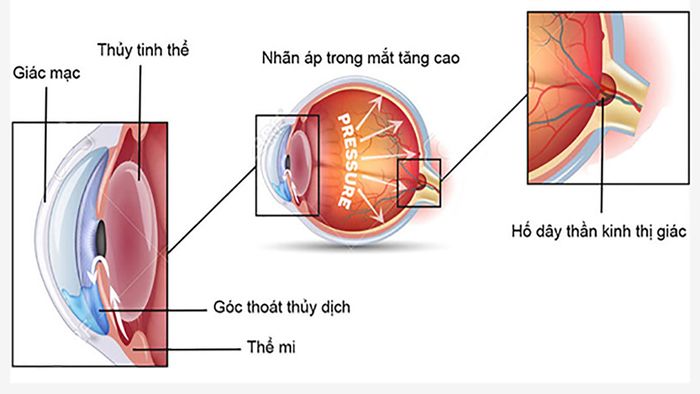 Tình trạng tăng áp lực trong mắt