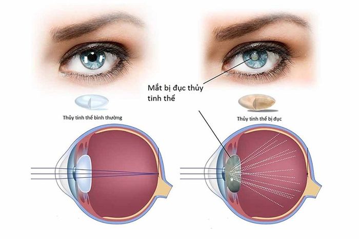 Nhức mỏi mắt kéo dài là một trong các dấu hiệu của vấn đề thủy tinh thể mờ mịt