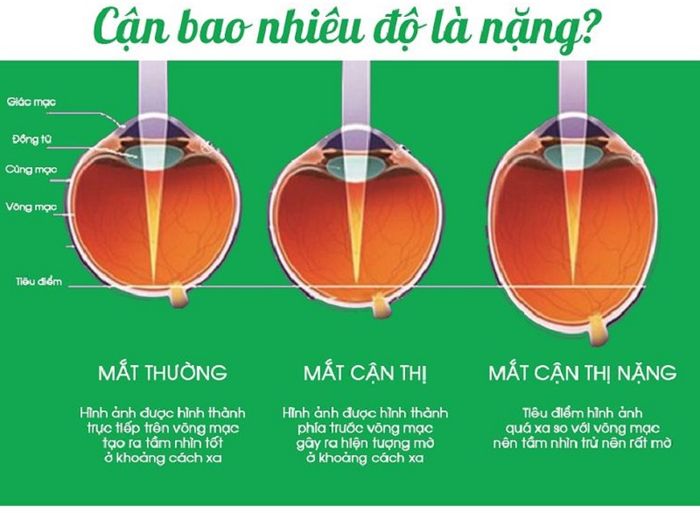 Mô phỏng về mức độ của cận thị