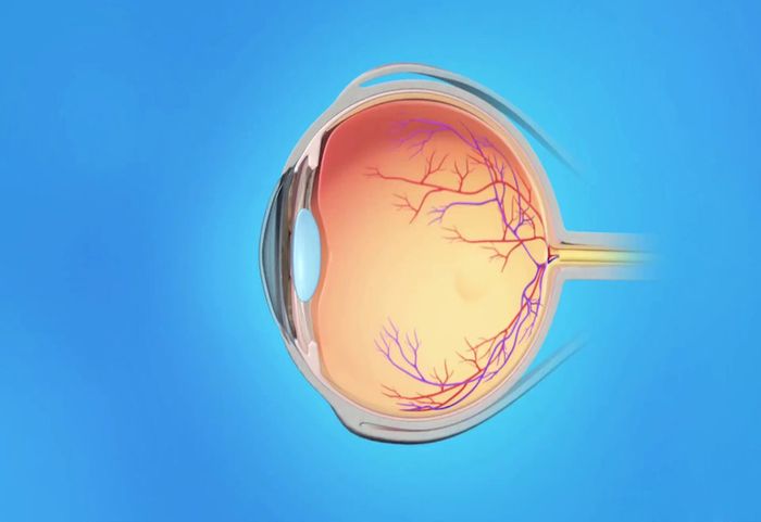 Bệnh có thể dẫn đến glaucoma, làm suy giảm thị lực.