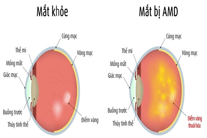 Bệnh thoái hóa điểm vàng AMD cũng được gọi là thoái hóa hoàng điểm