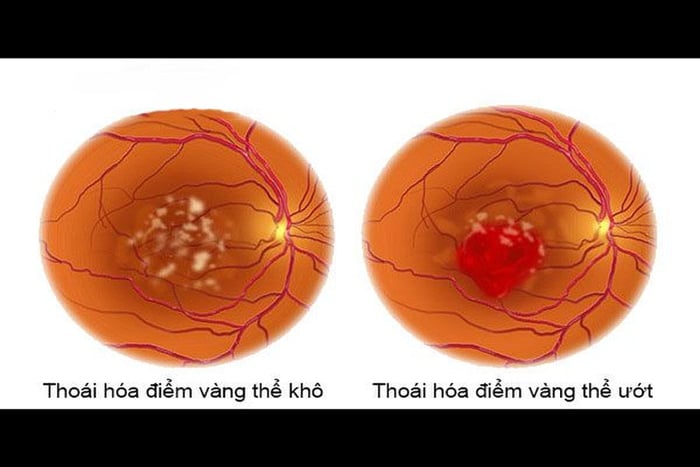 Bệnh thoái hóa điểm vàng có thể chia thành hai loại: thoái hóa điểm vàng thể khô và thoái hóa điểm vàng thể ướt.