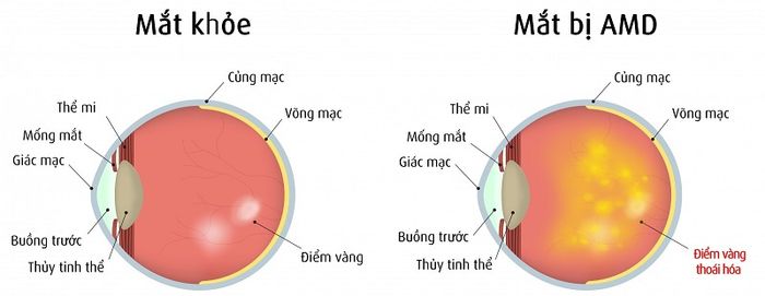 Suy thoái điểm vàng (ARMD hoặc AMD)