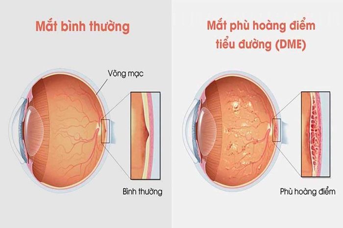 Phù hoàng điểm có thể phát sinh do biến chứng từ bệnh tiểu đường