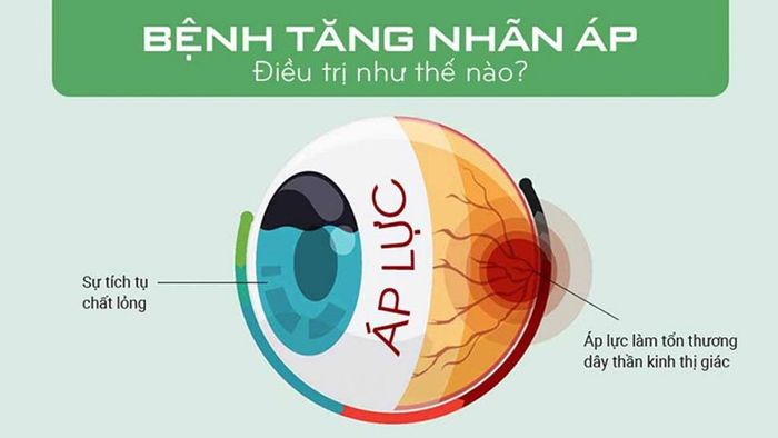 Có nhiều phương pháp điều trị tăng nhãn áp.