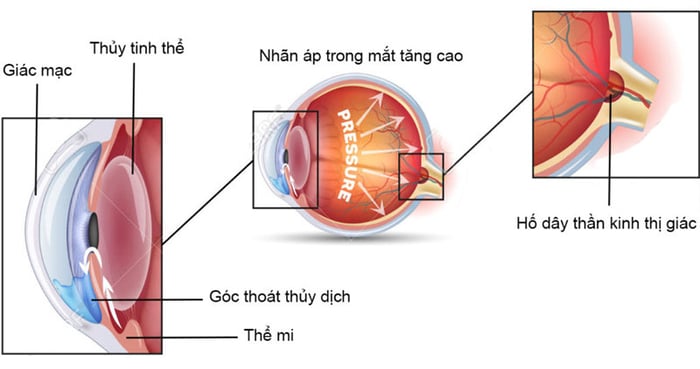 Bệnh tăng huyết áp là nguyên nhân chính gây mù lòa