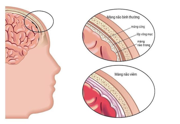 Phế cầu khuẩn có thể gây ra bệnh viêm màng não rất nguy hiểm.